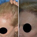 Hair Restoration Before and After Photos in Miami, FL, Patient 1660