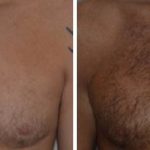 Hair Restoration Before and After Photos in Miami, FL, Patient 1678