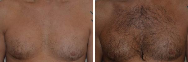 Hair Restoration Before and After Photos in Miami, FL, Patient 1678