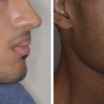 Hair Restoration Before and After Photos in Miami, FL, Patient 1683