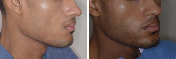 Hair Restoration Before and After Photos in Miami, FL, Patient 1683