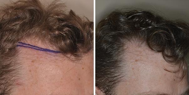 Hair Restoration Before and After Photos in Miami, FL, Patient 1589