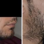 Hair Restoration Before and After Photos in Miami, FL, Patient 1687