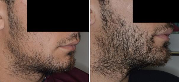 Hair Restoration Before and After Photos in Miami, FL, Patient 1687