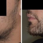 Hair Restoration Before and After Photos in Miami, FL, Patient 1687