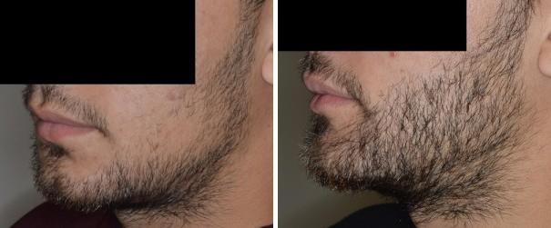 Hair Restoration Before and After Photos in Miami, FL, Patient 1687