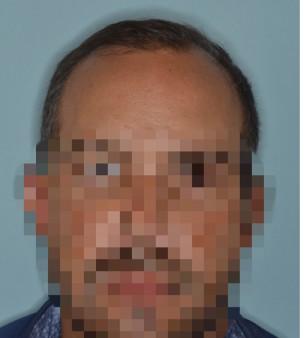 Hair Restoration Before and After Photos in Miami, FL, Patient 1694