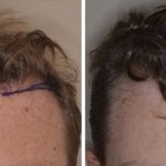 Hair Restoration Before and After Photos in Miami, FL, Patient 1589