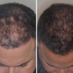 Hair Restoration Before and After Photos in Miami, FL, Patient 1733