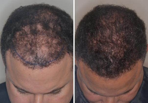 Hair Restoration Before and After Photos in Miami, FL, Patient 1733
