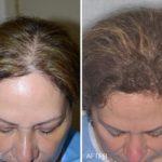 Hair Restoration Before and After Photos in Miami, FL, Patient 1596