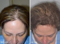 Hair Restoration Before and After Photos in Miami, FL, Patient 1596