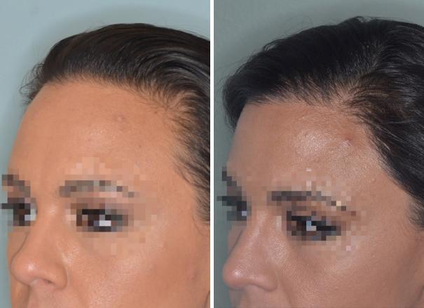 Hair Restoration Before and After Photos in Miami, FL, Patient 1745