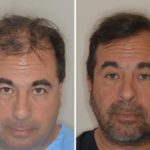 Hair Restoration Before and After Photos in Miami, FL, Patient 1755