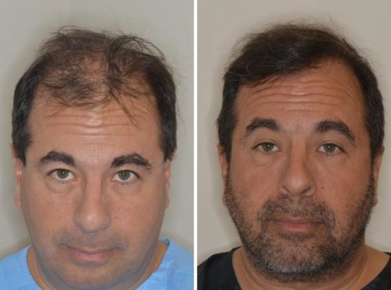 Hair Restoration Before and After Photos in Miami, FL, Patient 1755