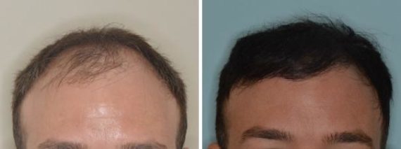 Hair Restoration Before and After Photos in Miami, FL, Patient 1764