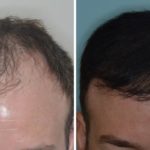 Hair Restoration Before and After Photos in Miami, FL, Patient 1764