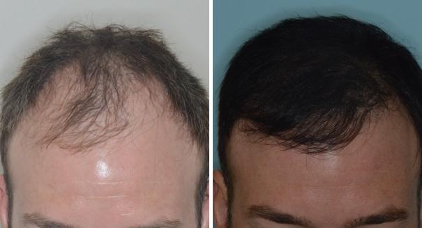 Hair Restoration Before and After Photos in Miami, FL, Patient 1764