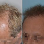 Hair Restoration Before and After Photos in Miami, FL, Patient 1774