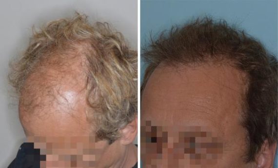 Hair Restoration Before and After Photos in Miami, FL, Patient 1774