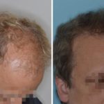 Hair Restoration Before and After Photos in Miami, FL, Patient 1774