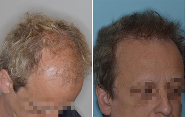 Hair Restoration Before and After Photos in Miami, FL, Patient 1774