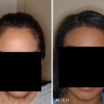 Hair Restoration Before and After Photos in Miami, FL, Patient 1600