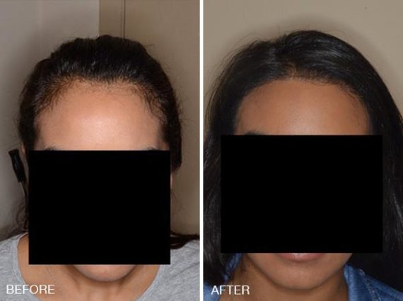 Hair Restoration Before and After Photos in Miami, FL, Patient 1600