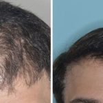 Hair Restoration Before and After Photos in Miami, FL, Patient 1788