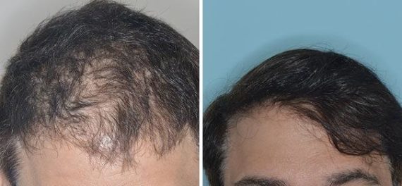 Hair Restoration Before and After Photos in Miami, FL, Patient 1788