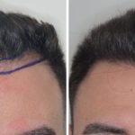 Hair Restoration Before and After Photos in Miami, FL, Patient 1795