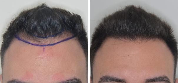 Hair Restoration Before and After Photos in Miami, FL, Patient 1795