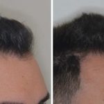 Hair Restoration Before and After Photos in Miami, FL, Patient 1795