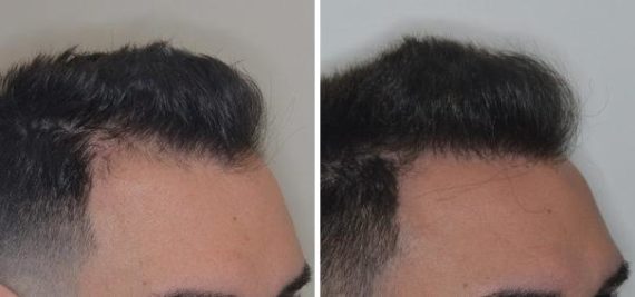 Hair Restoration Before and After Photos in Miami, FL, Patient 1795