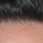 Hair Restoration Before and After Photos in Miami, FL, Patient 1795