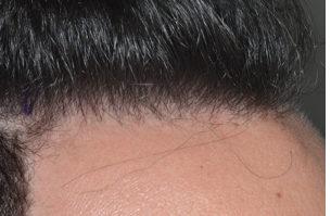 Hair Restoration Before and After Photos in Miami, FL, Patient 1795