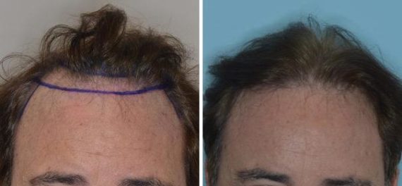 Hair Restoration Before and After Photos in Miami, FL, Patient 1804