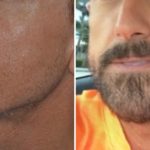 Hair Restoration Before and After Photos in Miami, FL, Patient 2030