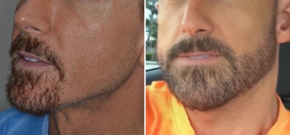 Hair Restoration Before and After Photos in Miami, FL, Patient 2030