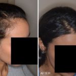 Hair Restoration Before and After Photos in Miami, FL, Patient 1600