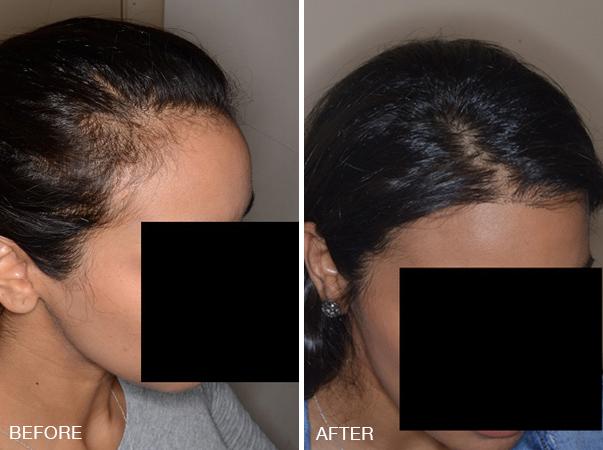 Hair Restoration Before and After Photos in Miami, FL, Patient 1600