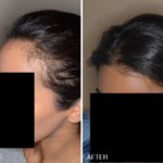 Hair Restoration Before and After Photos in Miami, FL, Patient 1600