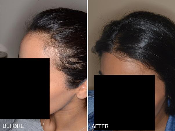 Hair Restoration Before and After Photos in Miami, FL, Patient 1600