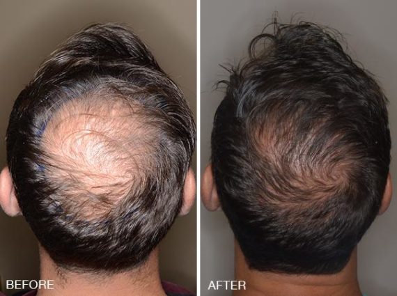 Hair Restoration Before and After Photos in Miami, FL, Patient 1610