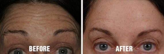 Injectables Before and After Photos in Miami, FL, Patient 1538