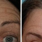 Injectables Before and After Photos in Miami, FL, Patient 1538