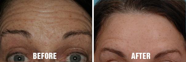 Injectables Before and After Photos in Miami, FL, Patient 1538