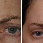 Injectables Before and After Photos in Miami, FL, Patient 1538