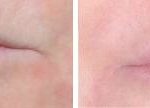 Injectables Before and After Photos in Miami, FL, Patient 1552