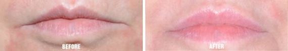 Injectables Before and After Photos in Miami, FL, Patient 1552